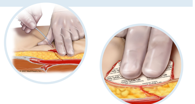 湖南益安生物動(dòng)脈止血貼：醫(yī)院手術(shù)與戰(zhàn)場急救的“生命守護(hù)盾”